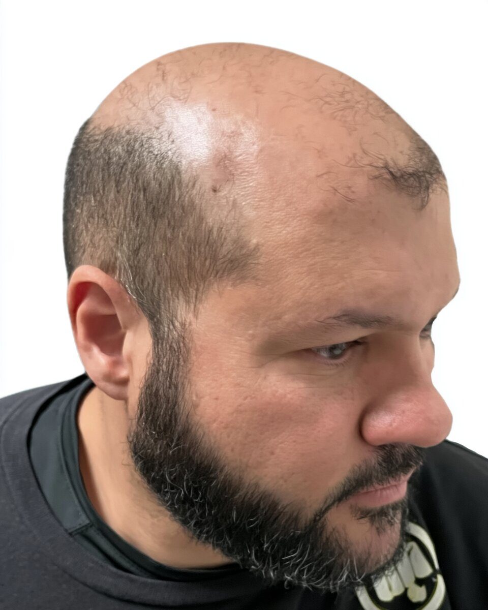 Full scalp, soft hairline: before treatment