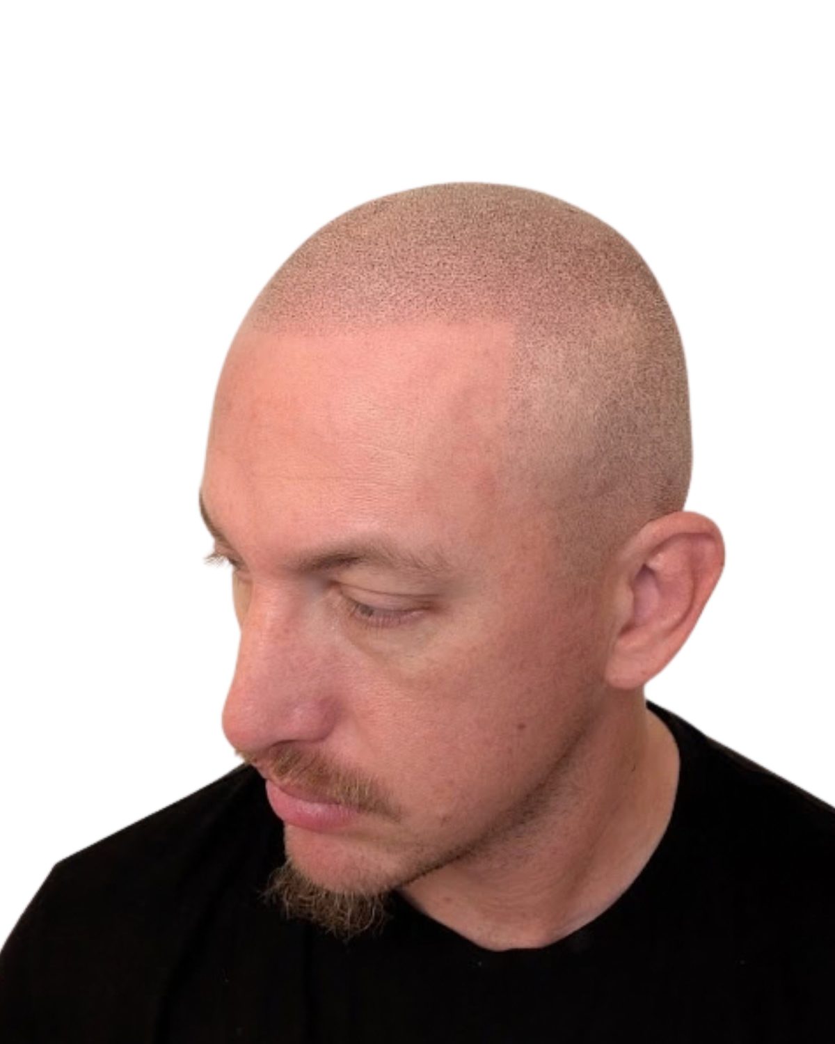 Density + soft hairline: after treatment
