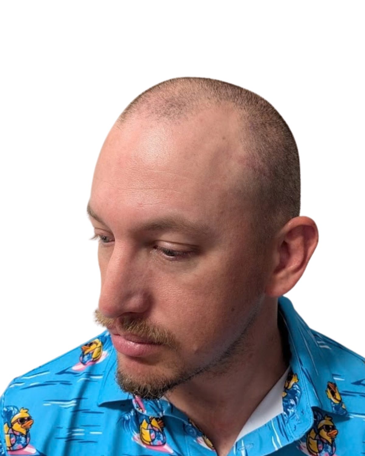 Density + soft hairline: before treatment
