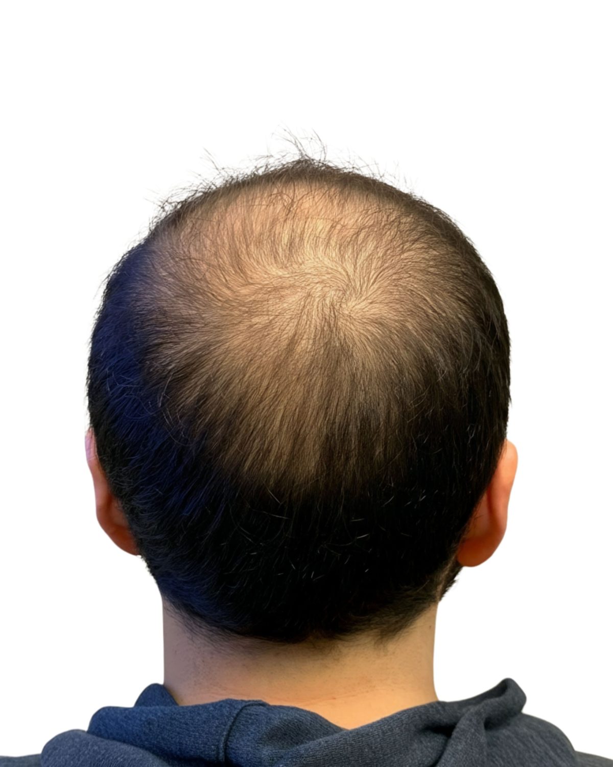 Density fill: before treatment