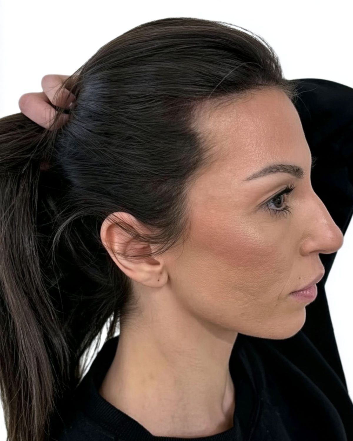 Case 08, thinning at the hairline and temples: after treatment