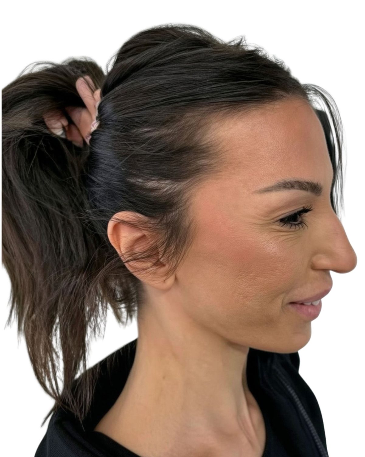 Case 08, thinning at the hairline and temples: before treatment