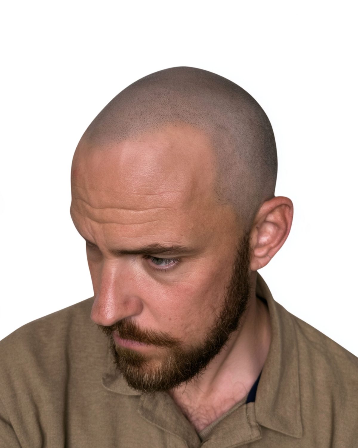 Full scalp, soft hairline: after treatment