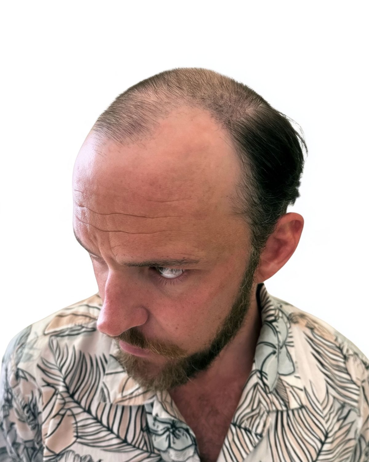 Full scalp, soft hairline: before treatment