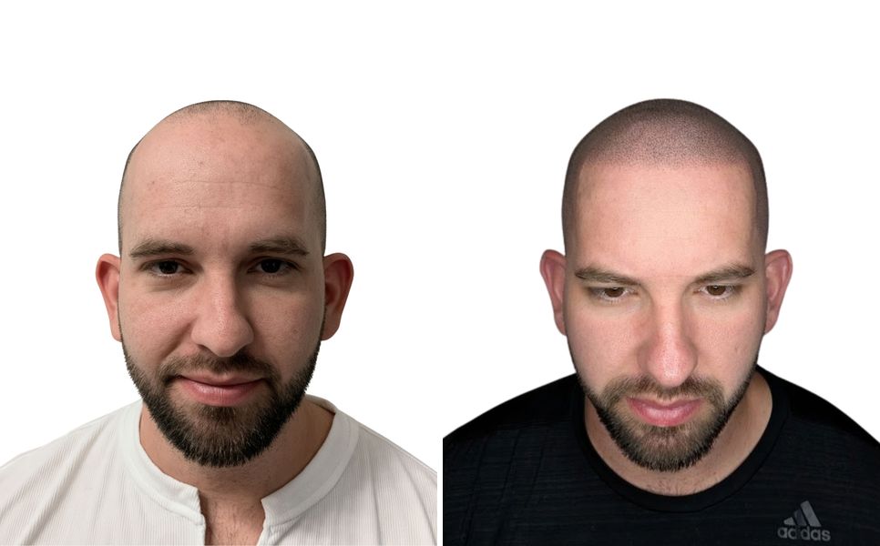 Before and after scalp micropigmentation by Karl: full scalp with a soft hairline