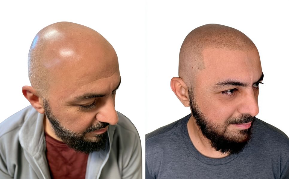 Before and after scalp micropigmentation by Karl: full scalp, natural look